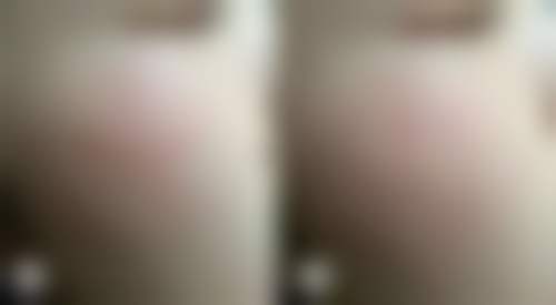 多次激光治疗的间隔时间