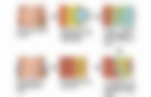 疤痕体质有疤怎么去除？药物、激光、手术等多种祛疤方法任你选