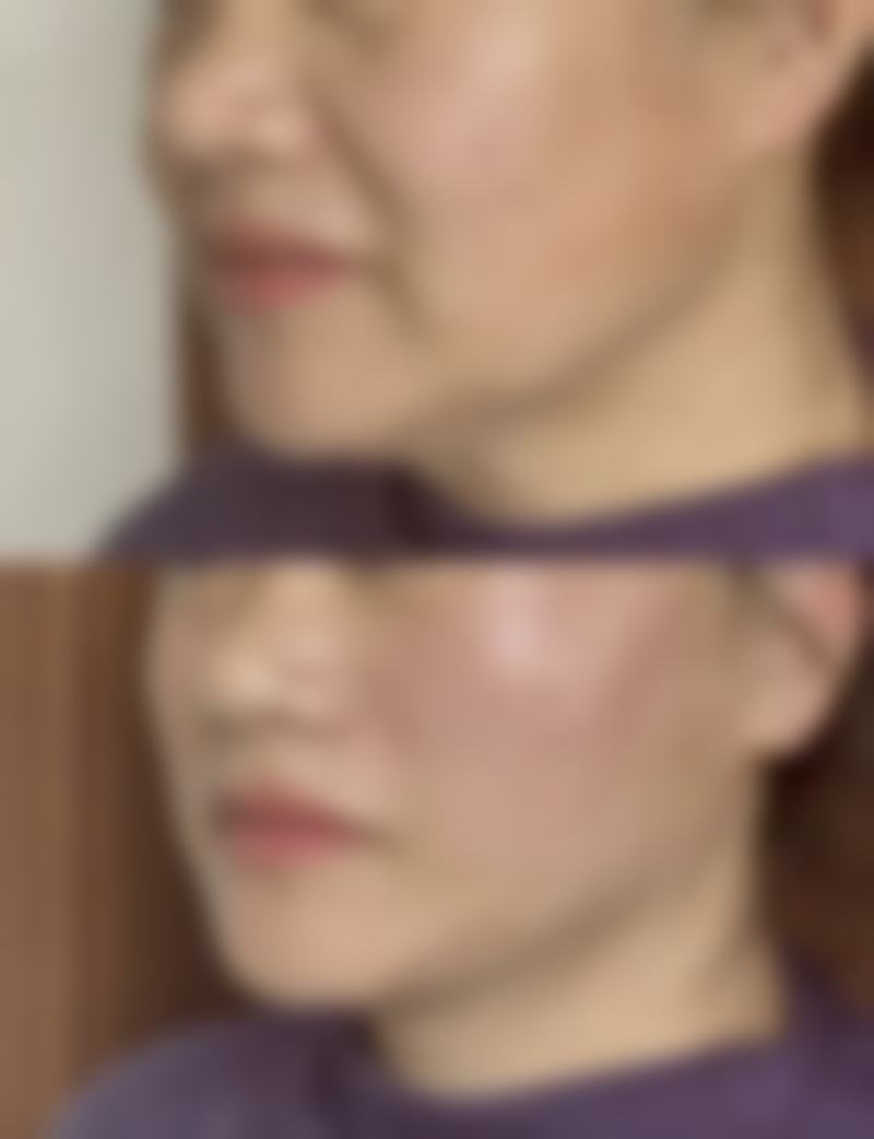 疤痕增生不医疗会引发并发症