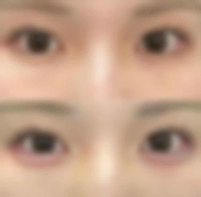 先做近视手术再做双眼皮手术的情况
