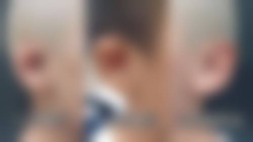 注射瘦脸针后需要注意什么