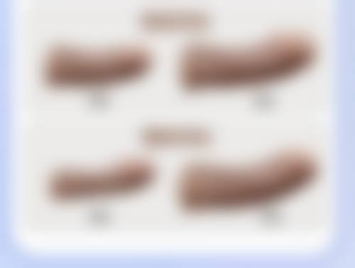 影响面部吸脂后反弹的因素