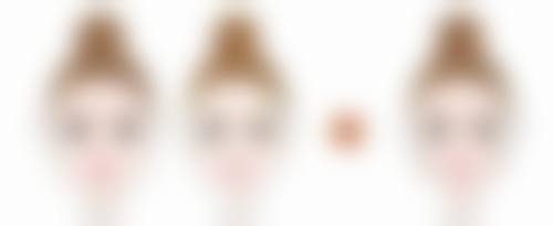 类固醇激素药物,针对增生性疤痕