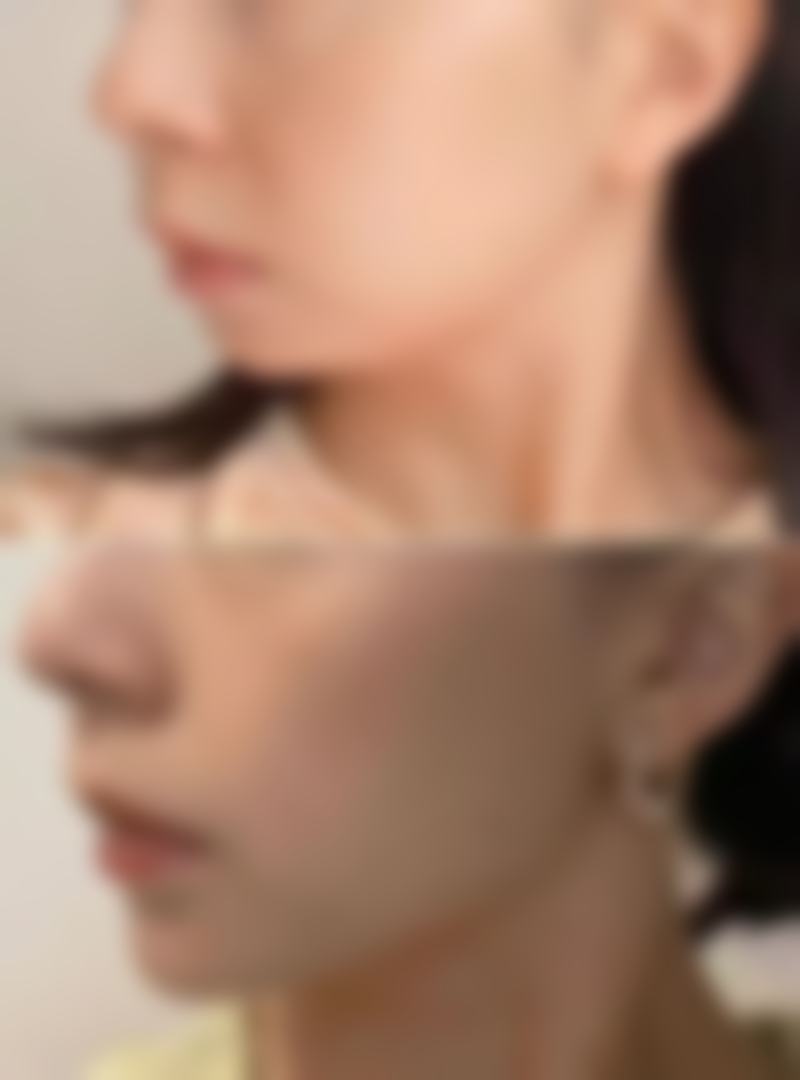 使用疤克的注意事项