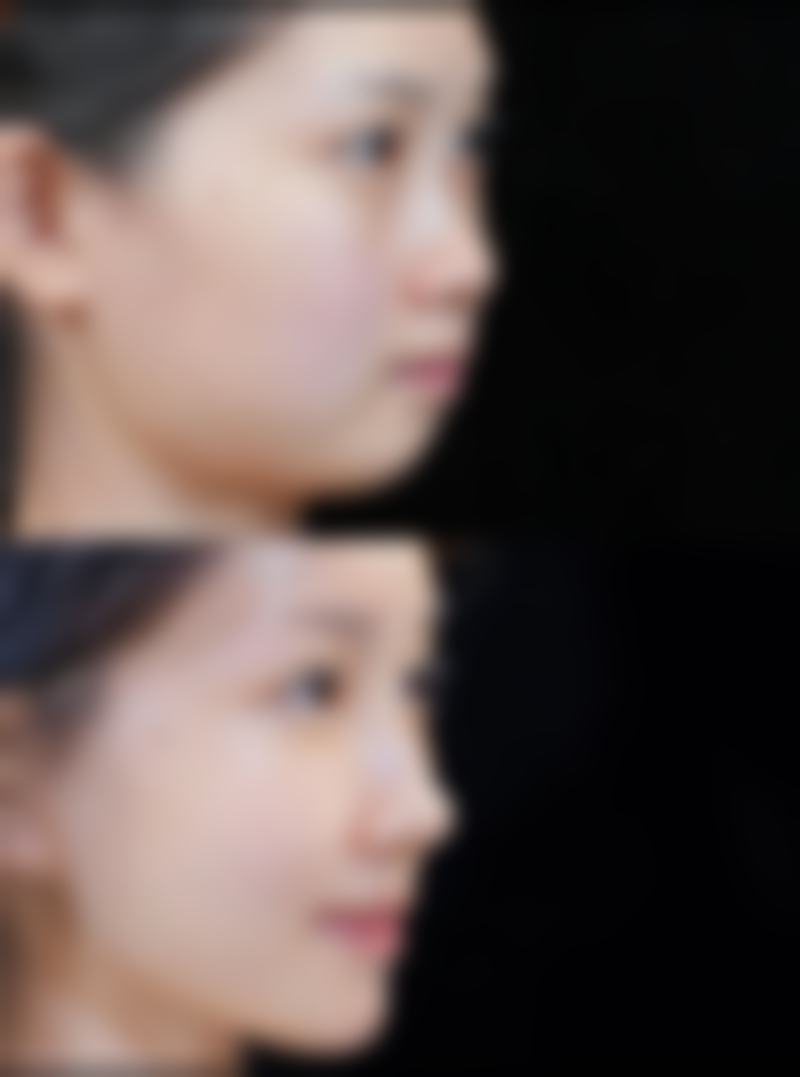 总结——韩国博朗温整形外科医院刘东万医生怎么样?