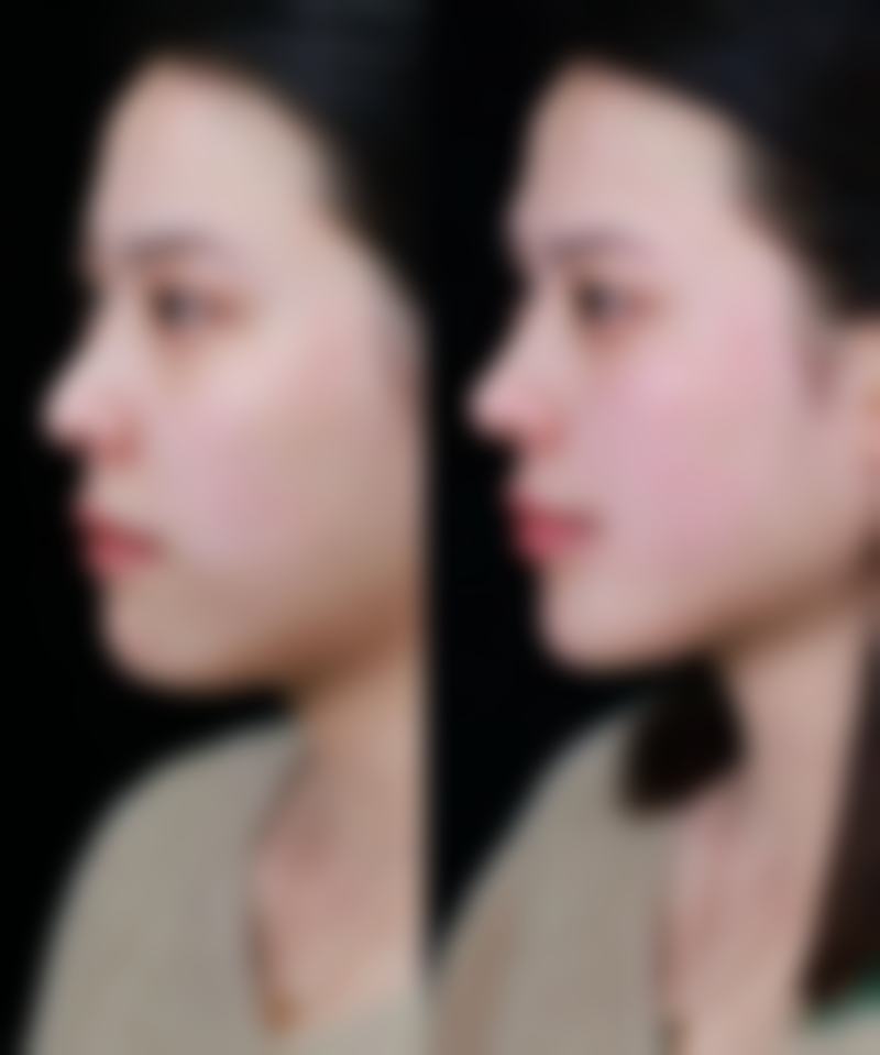拆线前后护理