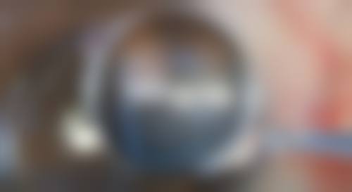 如何判断是否适合做双眼皮手术