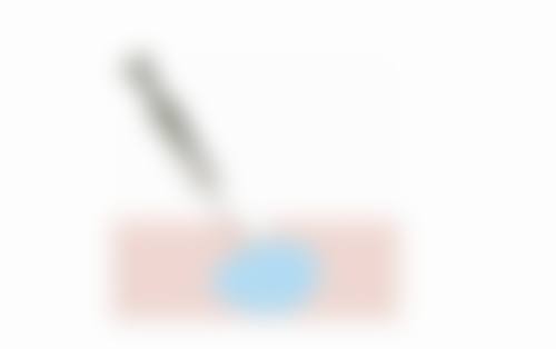 抽脂填充成效维持时间的个体差异