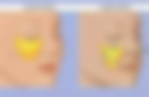 腹部抽脂后运动对修复和成效的影响