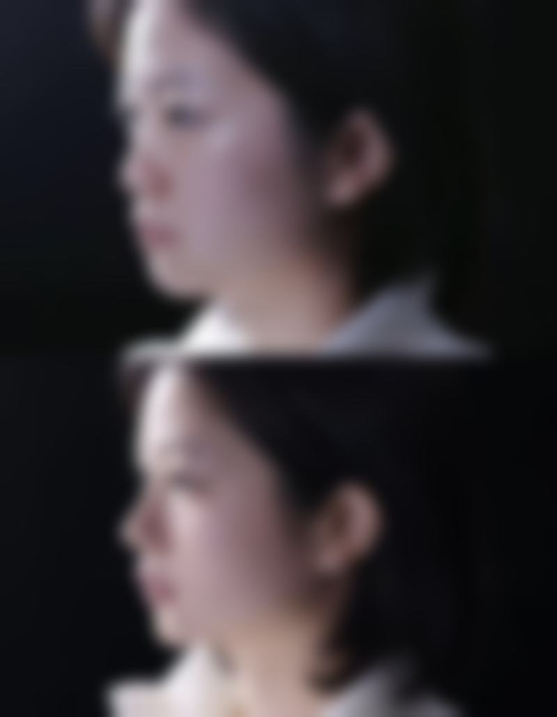 rose双眼皮是割的吗？无确凿证据，常见手术方法及适用人群你了解吗