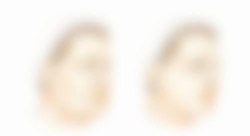 做双眼皮消肿的常见误区