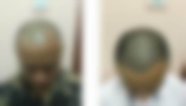 合肥曙光植发医疗美容门诊部收费标准参考