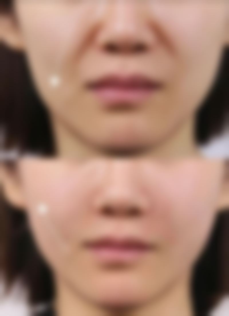 什么情况下需要及时就医处理双眼皮第四天的肿胀
