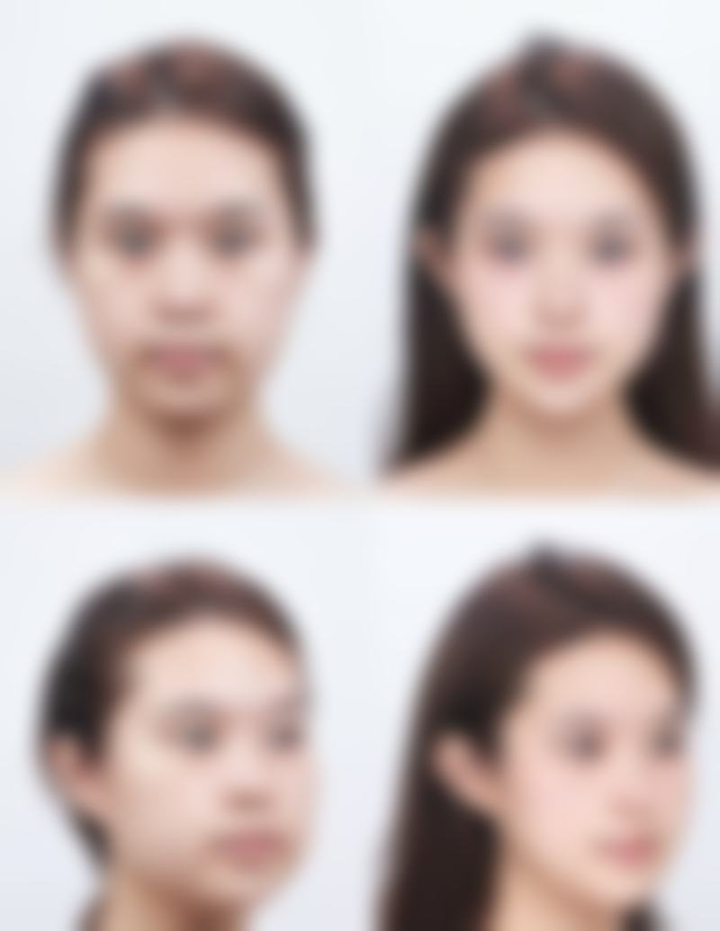 面部除皱成效受哪些因素影响