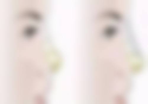 四眼皮变回双眼皮后的维护