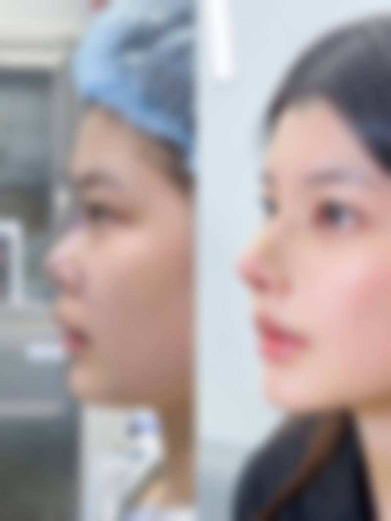 激光治疗去除点痣留下的凸起疤痕