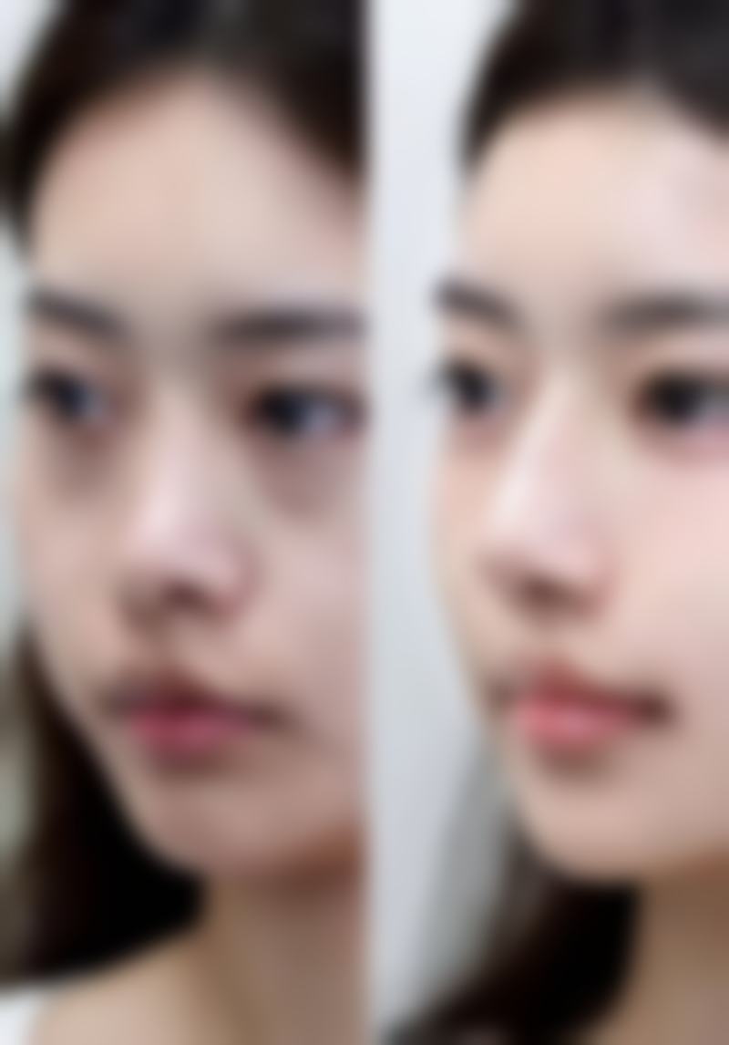 磨削治疗大面积多发性痘坑