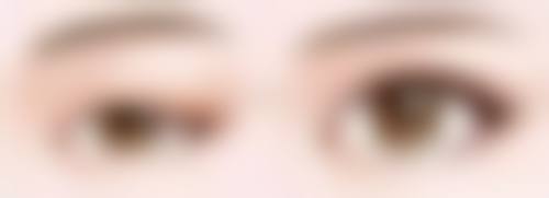 术后早期出现大小眼该怎么办