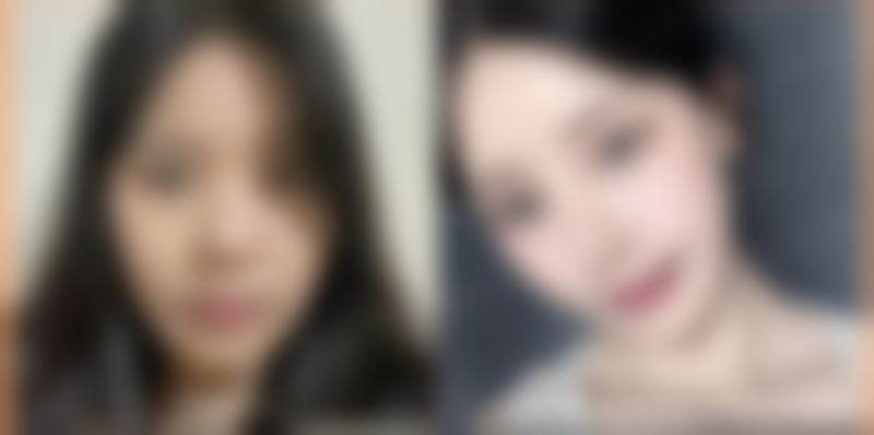 拉皮除皱手术价格与成效的关系