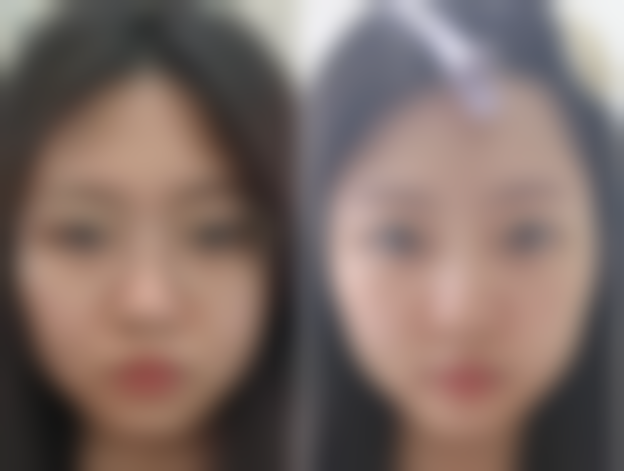 磨平凸起疤痕后如何护理