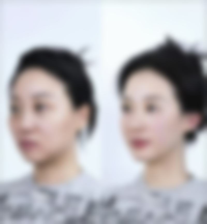 西安诺颜整形美容诊所陈一言医生技术好不好?