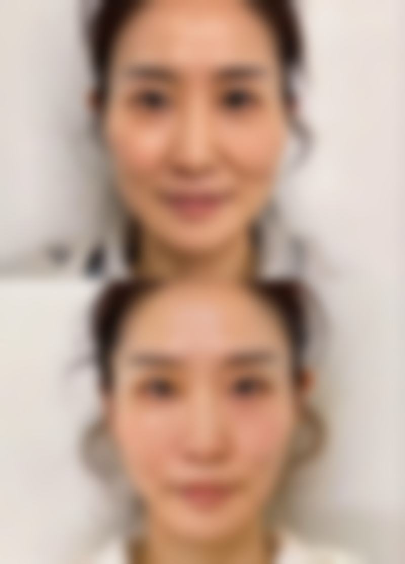 硅胶和膨体在不同方面的成效对比