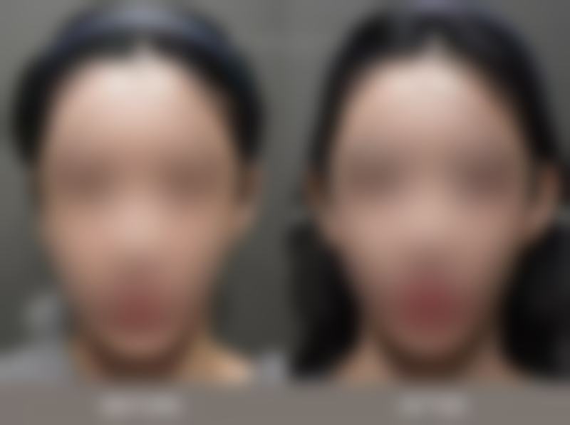 隆胸手术的心理危害