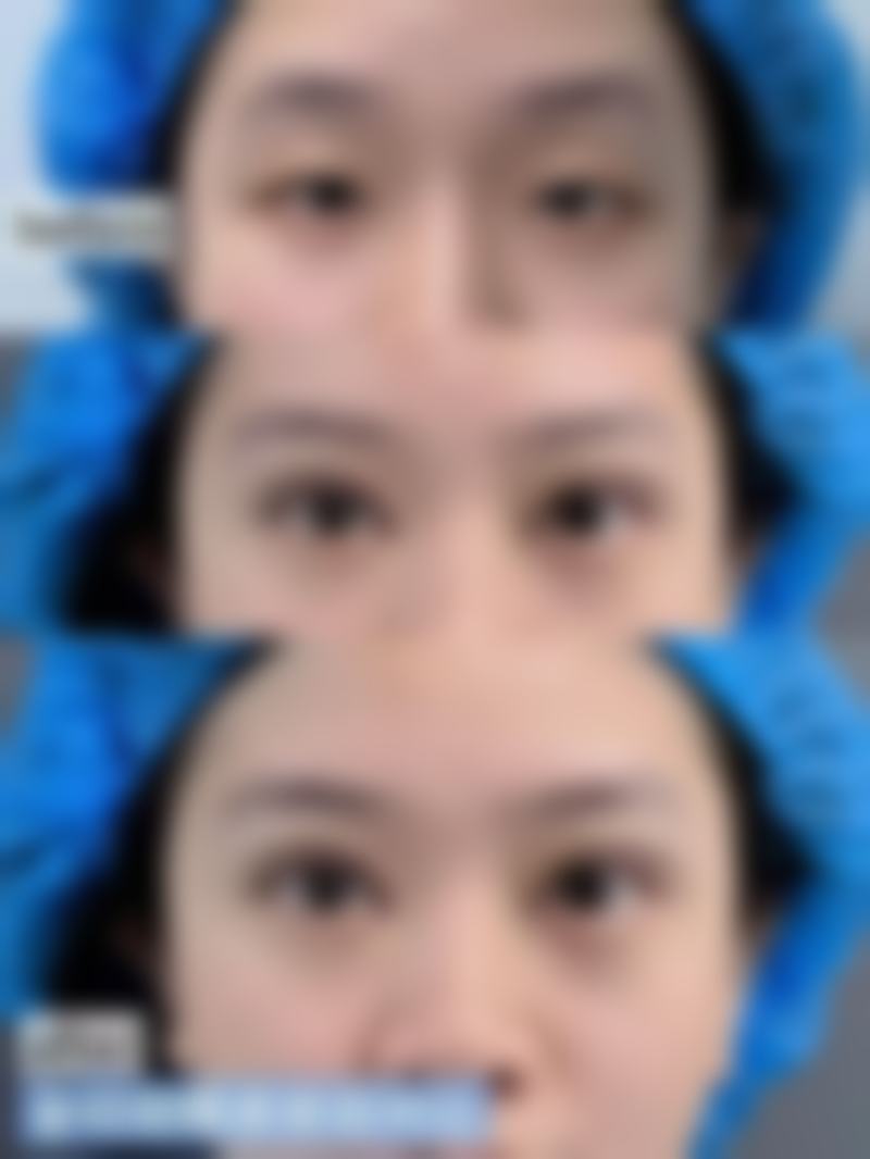 假体的隆胸对身体有害吗？潜在危害可避免，还有适应性强等诸多好处