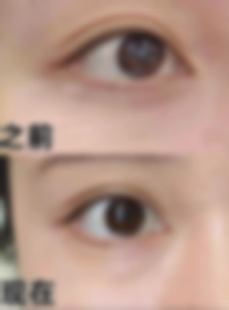 打瘦脸针时的注意事项