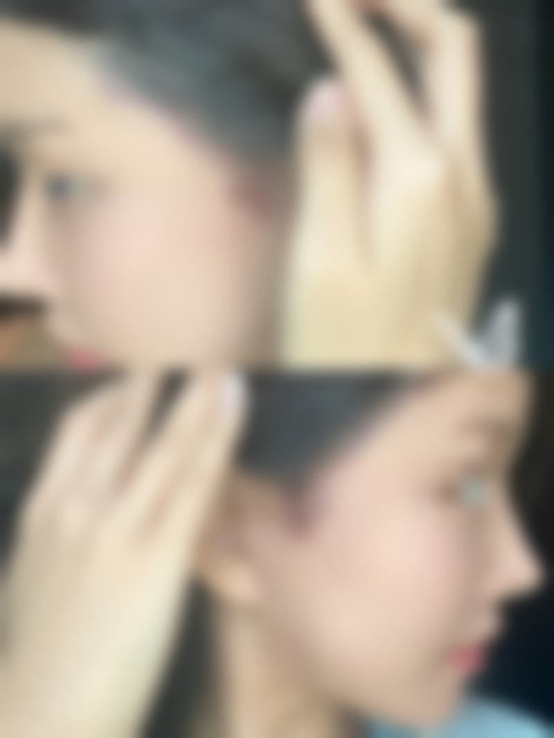 不同手术方式的修复时间差异