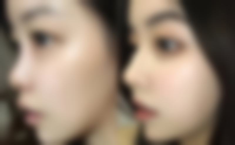 注射隆胸取出的手术级别和修复护理