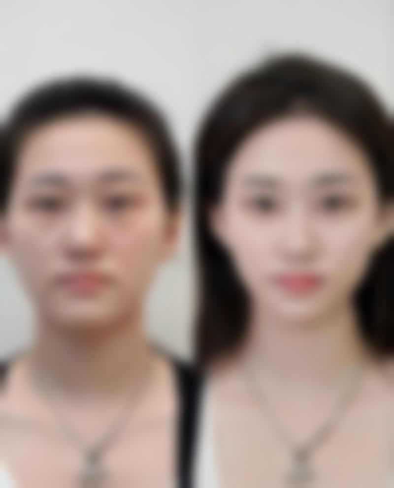 加速隆鼻手术消肿的方法