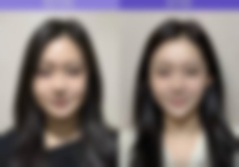 淡化面部凹陷疤痕的日常注意事项