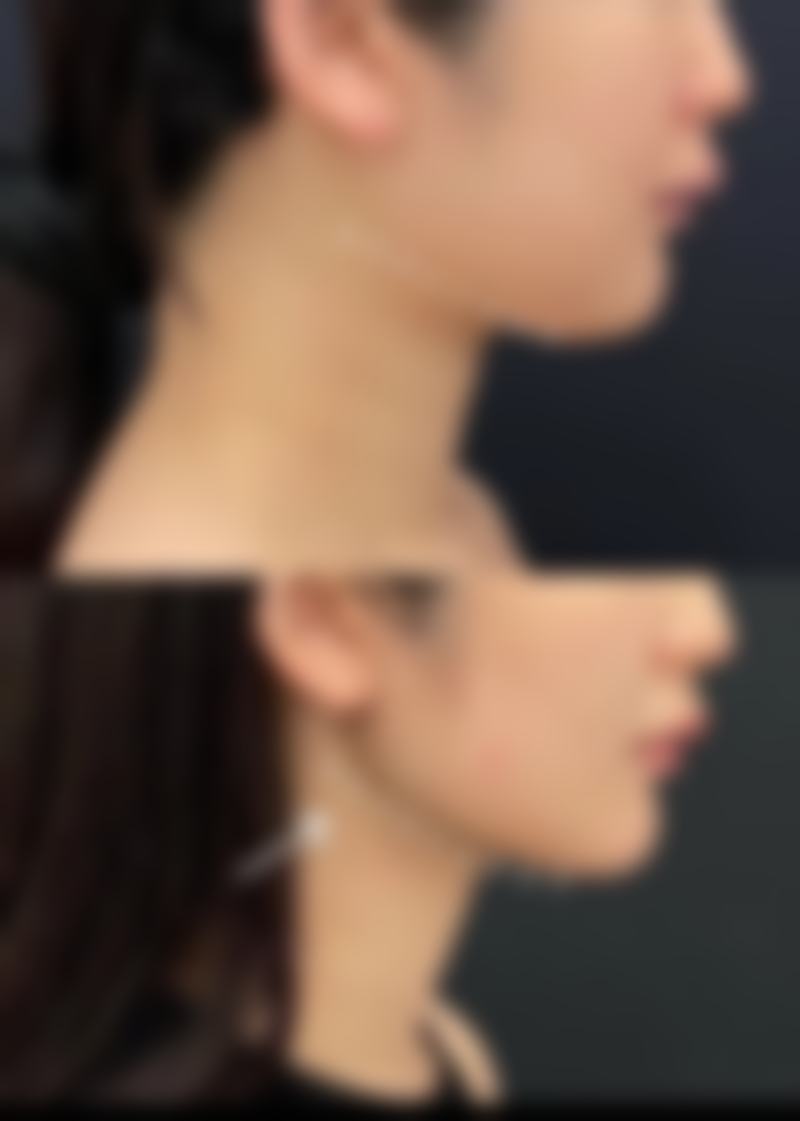 皱纹形成的原因