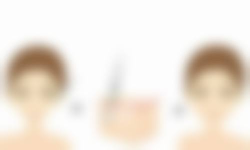 哪些因素会影响扎除皱针的安心性