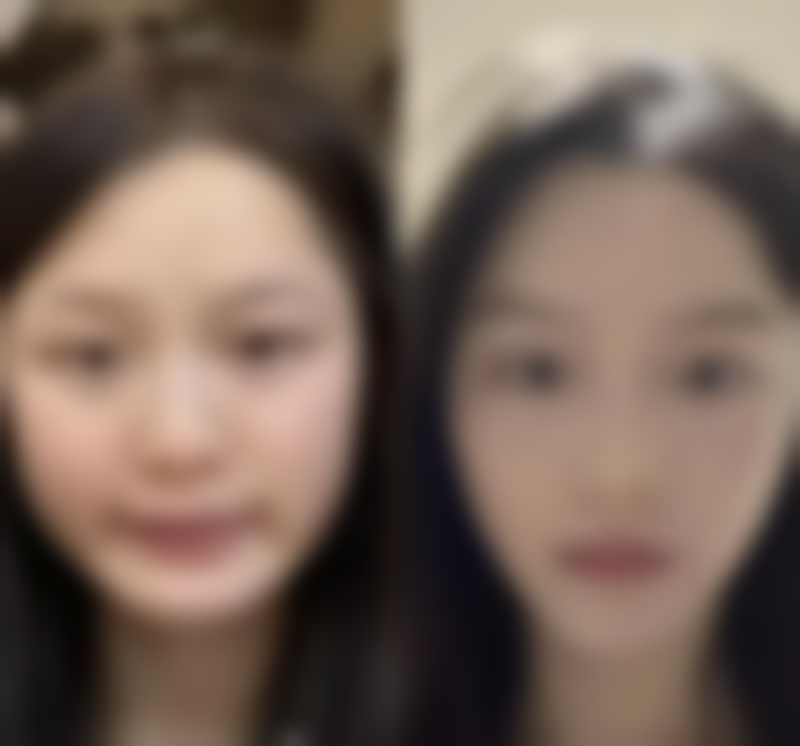 打了瘦脸针没成效,是不是术后护理没做好?