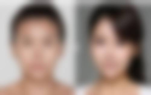 总结隆胸假体可以维持多少年