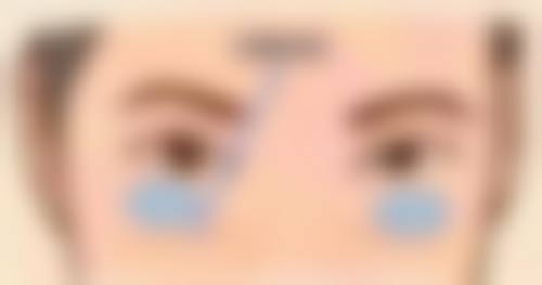 割了双眼皮六天拆线的风险