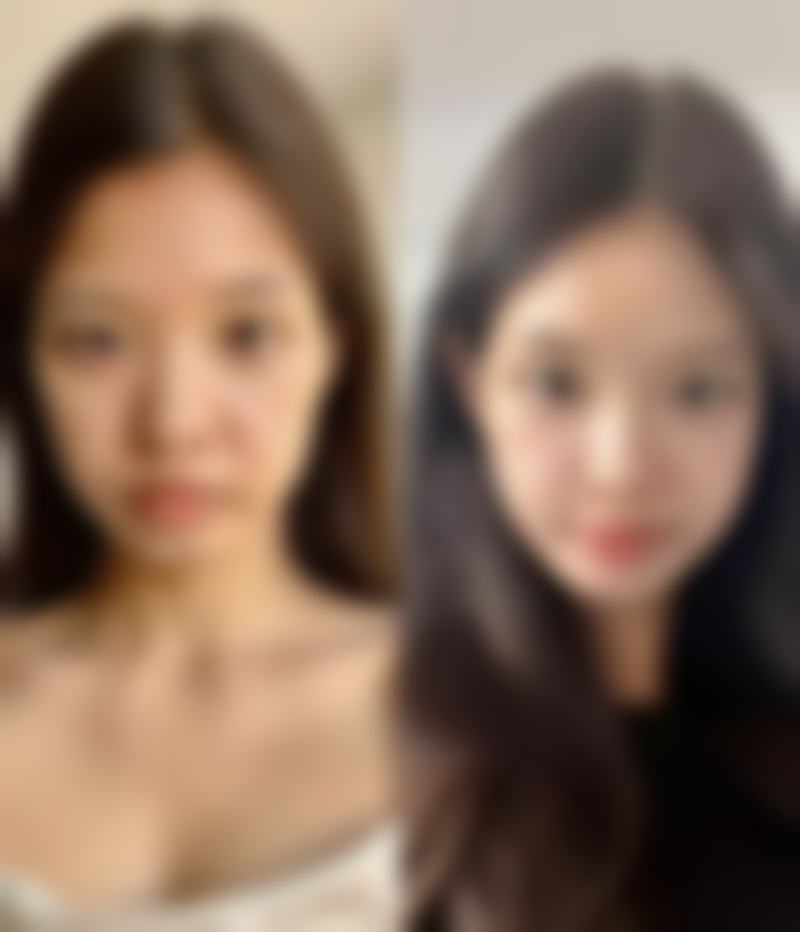 12岁女生因不良生活习惯导致眼袋重怎么办