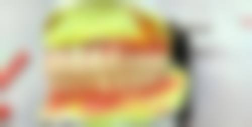 优惠活动详情：儿童龋齿治疗限时特别优惠