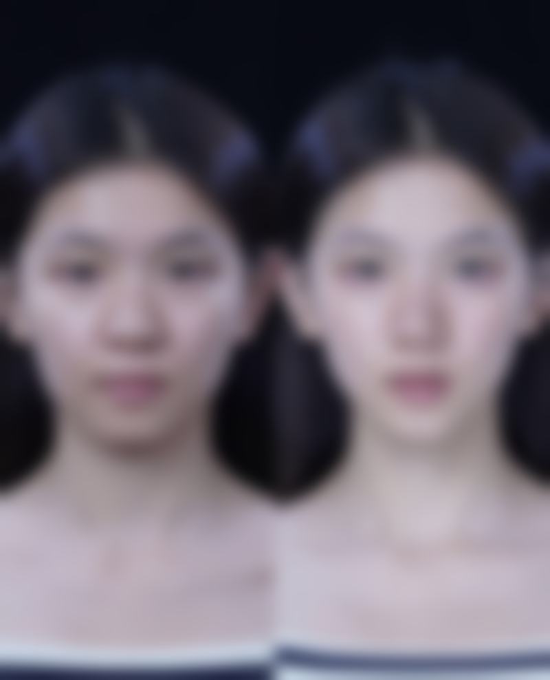 割完双眼皮后的其他注意事项