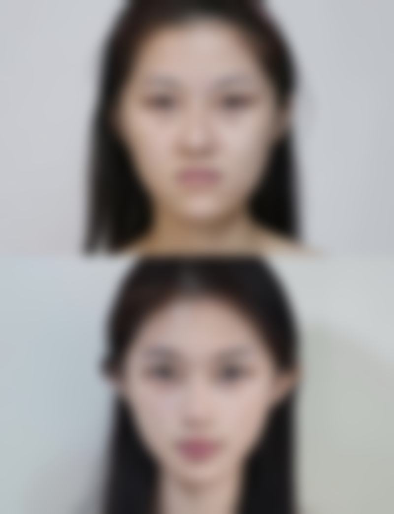 眼综合手术项目介绍