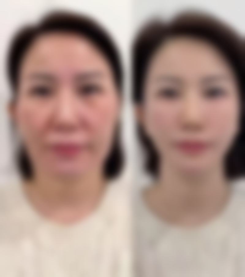手术治疗怎样祛除下眼袋