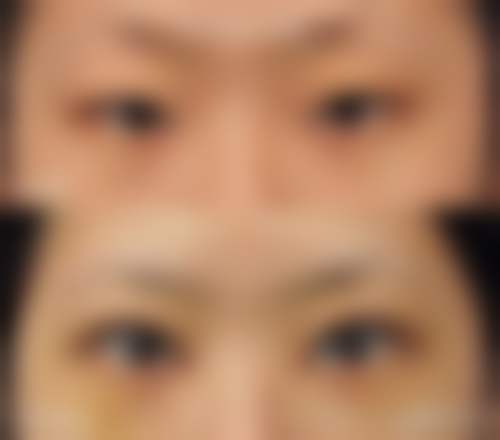天津紫洁医美眼部整形的优势是什么?