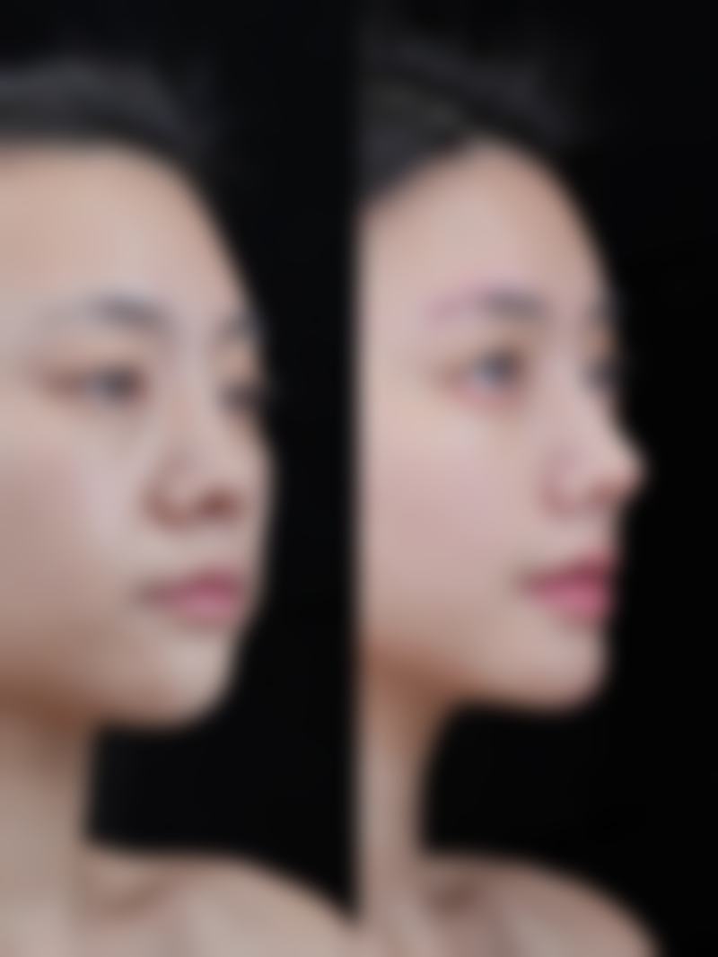选择医美项目怎么去除眼袋和黑眼圈呀